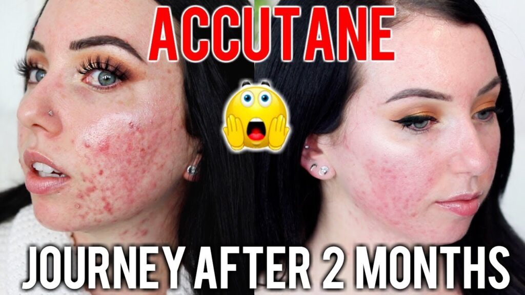 Accutane Before and After: What to Expect